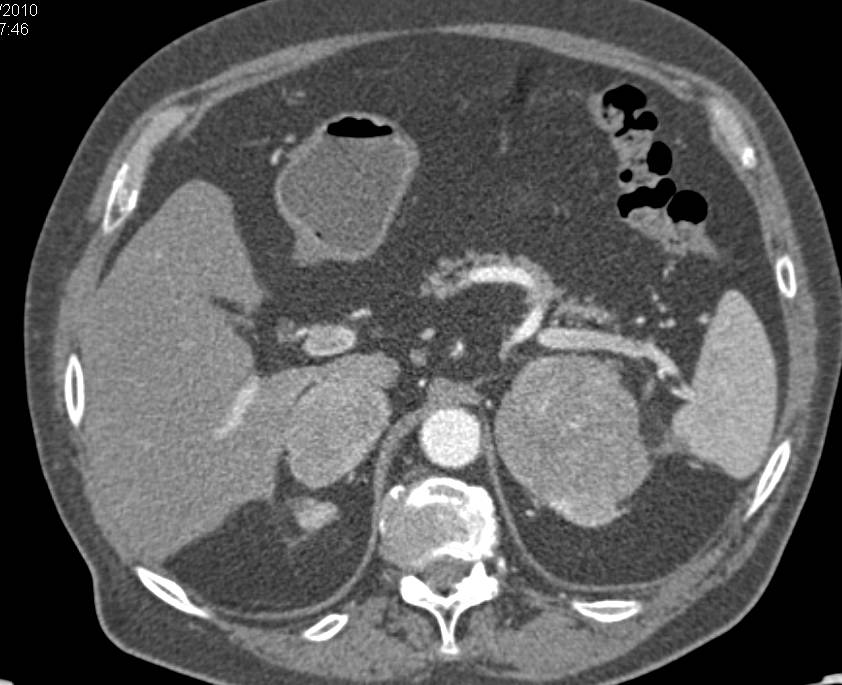 Renal Cell Carcinoma Metastatic to the Adrenal Glands - CTisus CT Scan