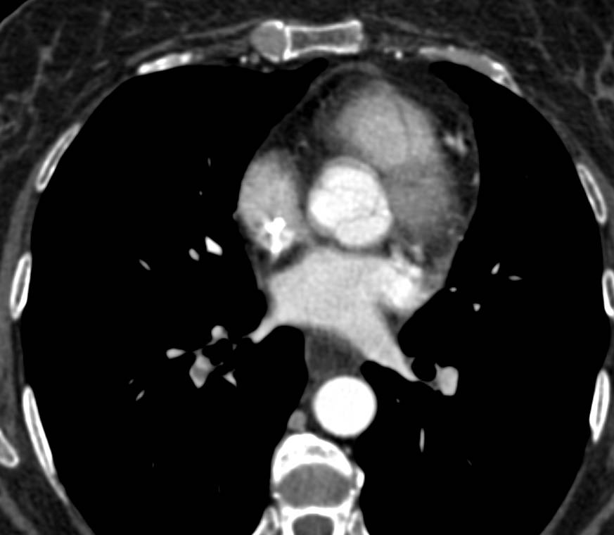 Cholangiocarcinoma - CTisus CT Scan