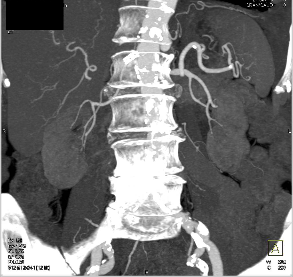 Abdominal Aortic Aneurysm (AAA) with Stents in the Renal Arteries - CTisus CT Scan