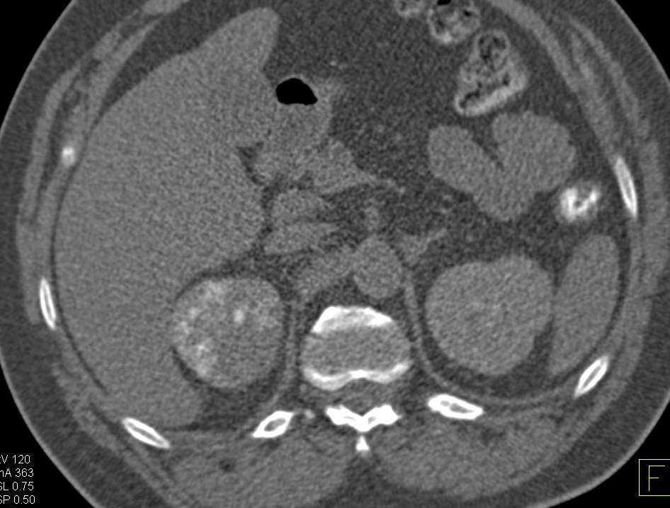 Acute Pyelonephritis with Patchy Nephrogram Best Seen on Late Phase Imaging as Well as Arterial Phase Imaging. Striated Nephrogram seen. - CTisus CT Scan