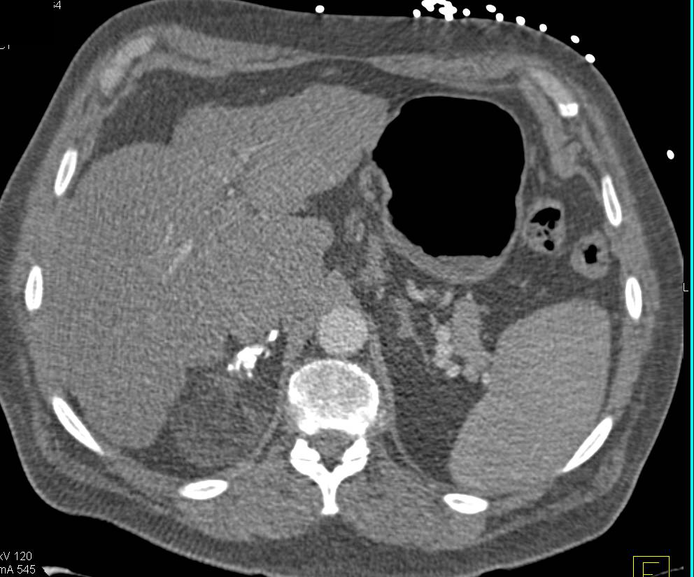 Right Adrenal Myelolipoma with Calcification - CTisus CT Scan