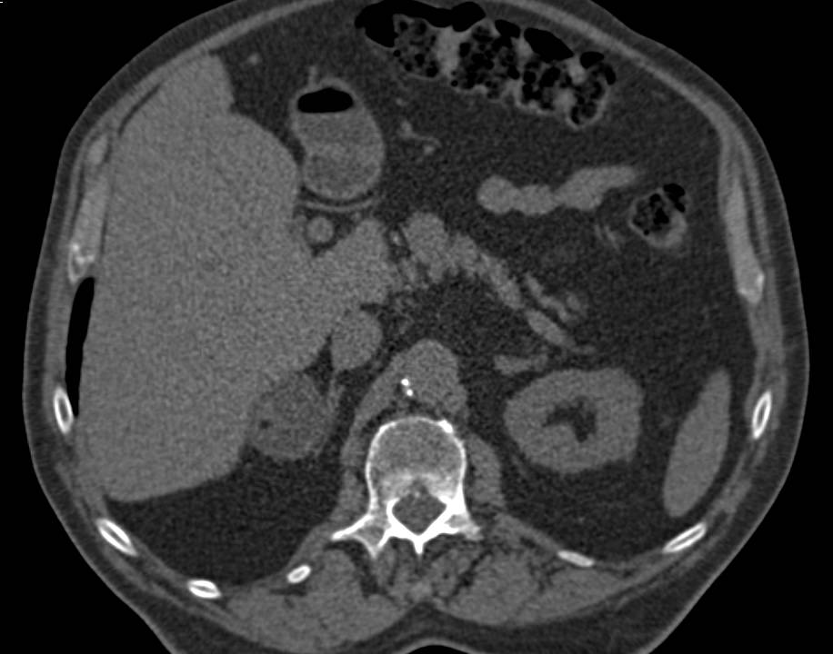 Right Adrenal Myelolipoma - CTisus CT Scan