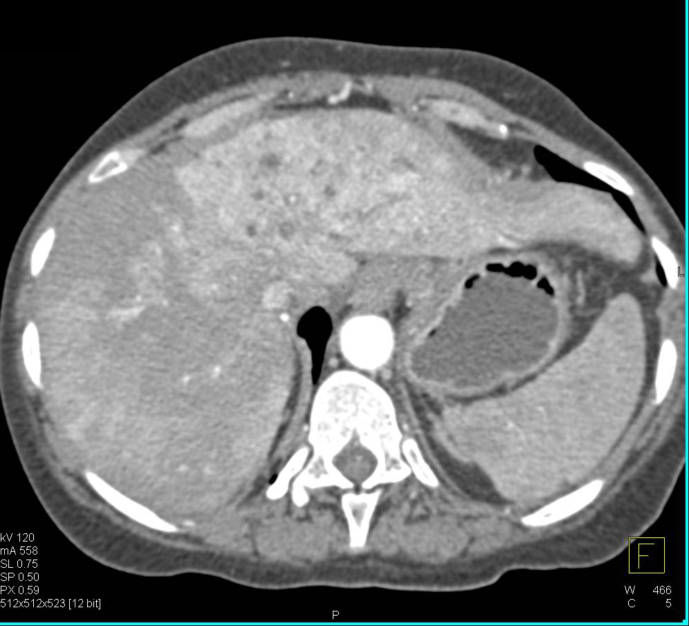 Cholangiocarcinoma of the Liver with Left Dilated Ducts and Tumor in Porta Hepatis. Perfusion Changes Liver and Tumor Best Seen on Delayed Images - CTisus CT Scan