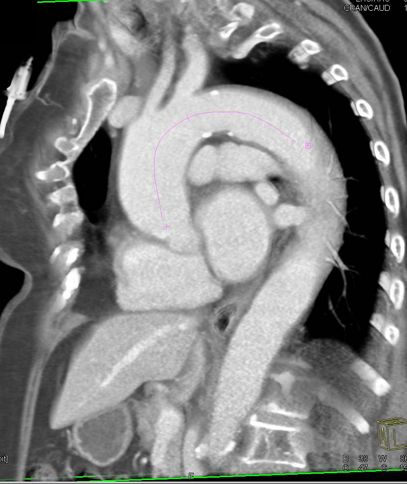 Dilated Ascending Aorta with Volume Measurements and Vessel Tracking - CTisus CT Scan