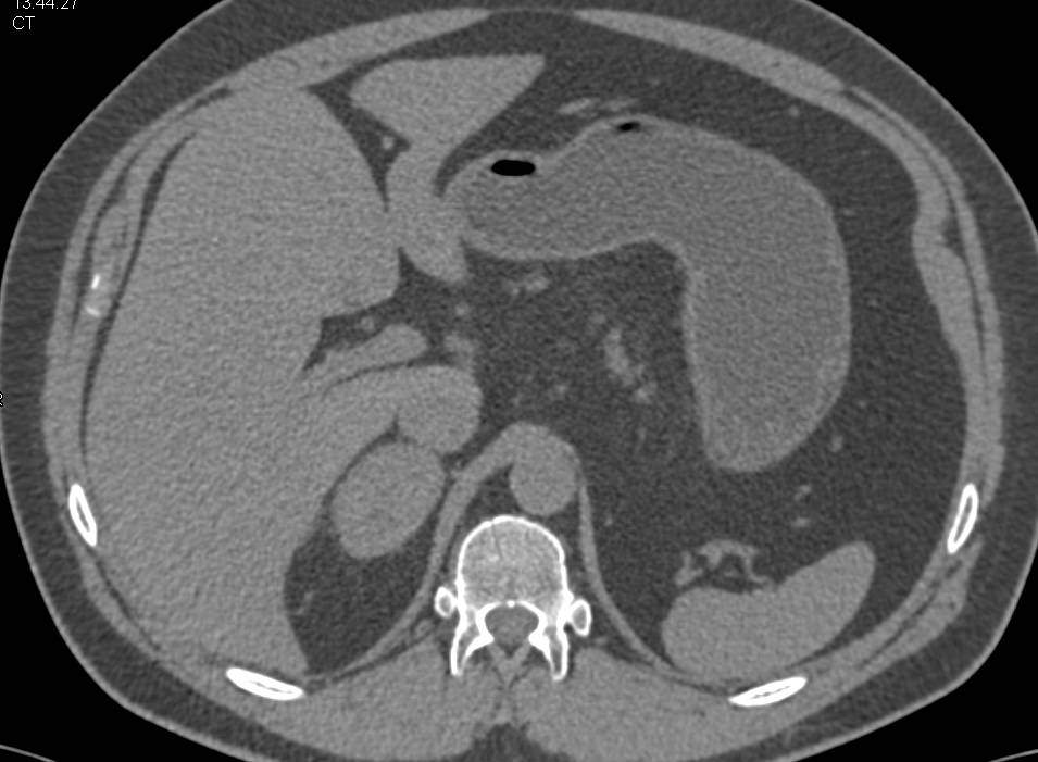 Pheochromocytoma of the Right Adrenal Gland - CTisus CT Scan