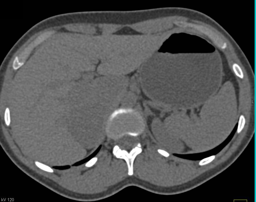 Primary Adrenal Carcinoma - CTisus CT Scan