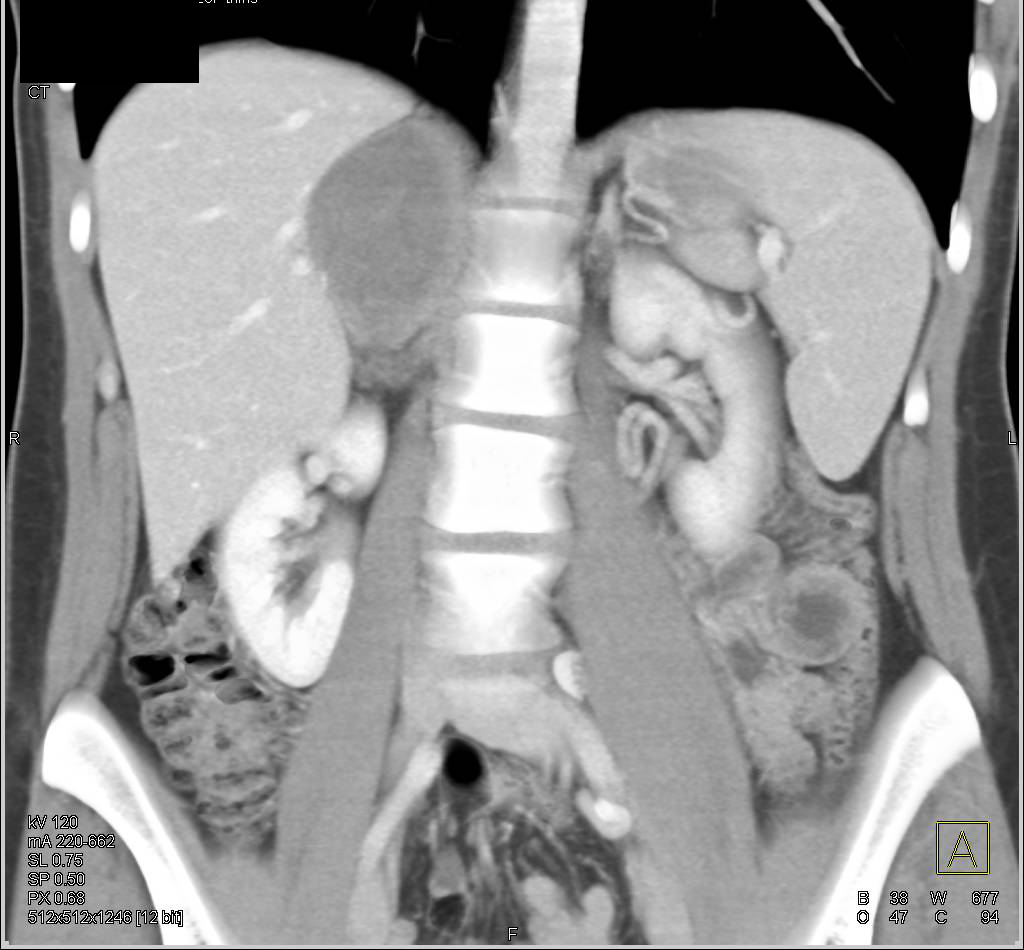 Primary Adrenal Carcinoma Adrenal Case Studies Ctisus Ct Scanning