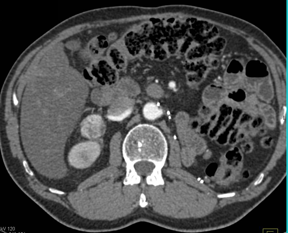 Renal Cell Carcinoma Metastatic to the Contralateral Adrenal - CTisus CT Scan