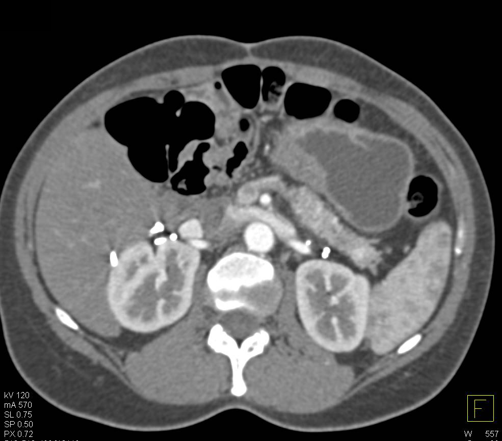 Bilateral Adrenalectomties - CTisus CT Scan