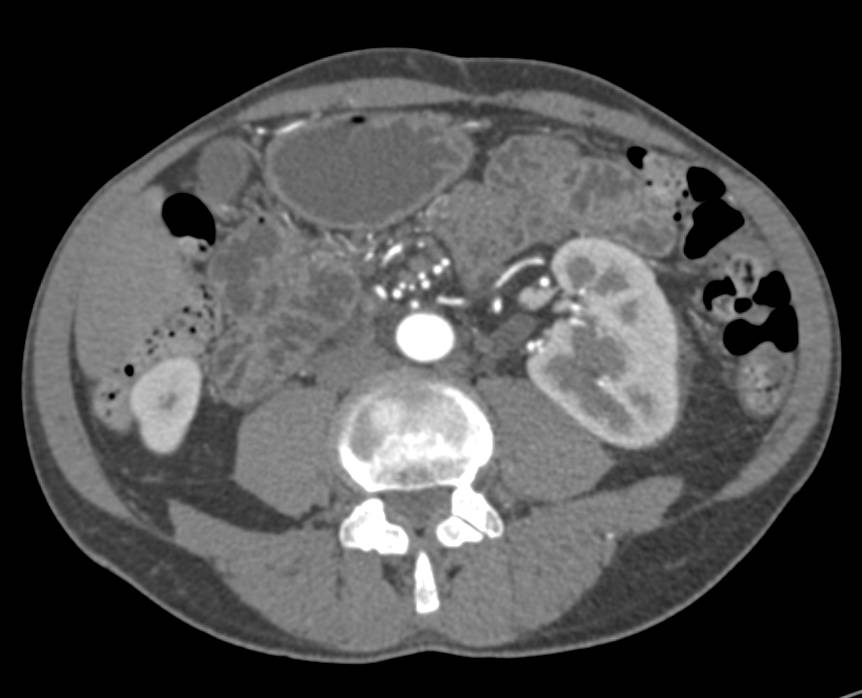 Primary Adrenal Carcinoma - CTisus CT Scan