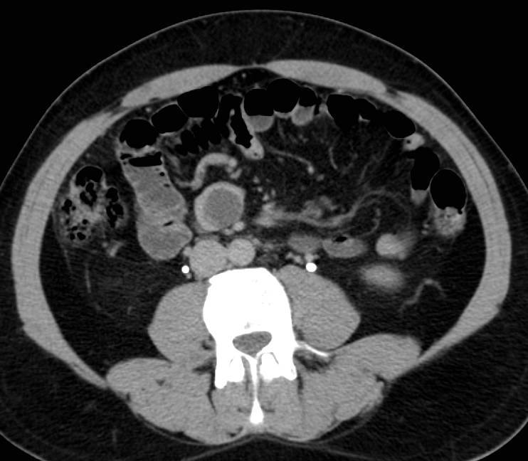 Carcinoid Tumor in the Mesentery - CTisus CT Scan