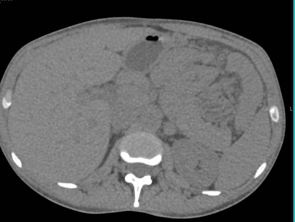 Lipid Poor Adrenal Adenoma - CTisus CT Scan