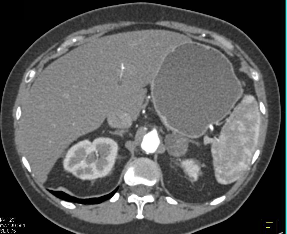 Lipid Poor Left Adrenal Adenoma as Incidental Finding on CT Enterography Study - CTisus CT Scan