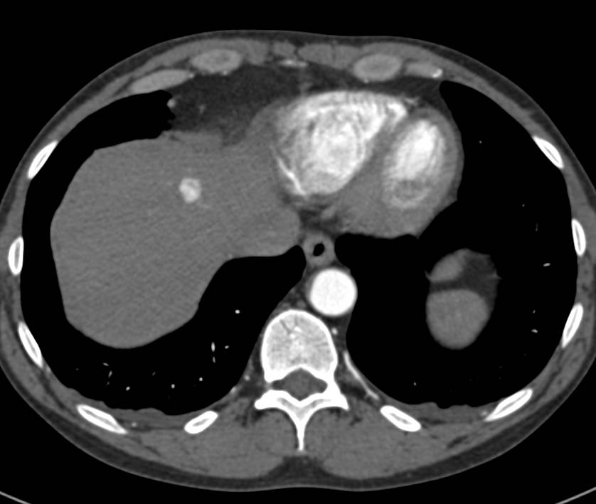 Vascular Liver Lesions due to Neuroendocrine Tumor - CTisus CT Scan