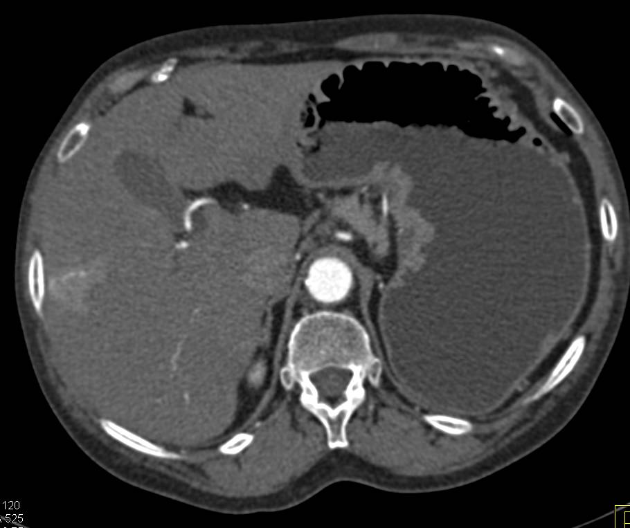 Hepatic Hemangioma - CTisus CT Scan