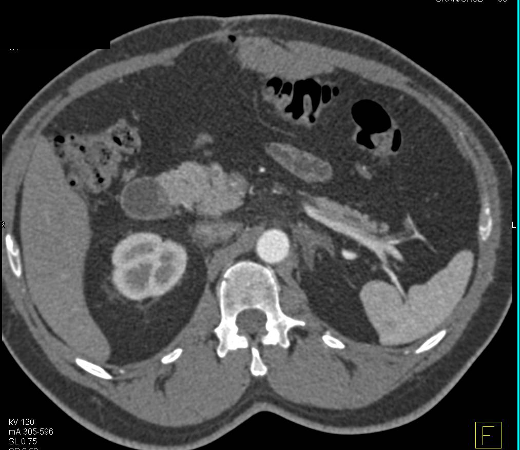 Left Adrenal Hyperplasia - CTisus CT Scan