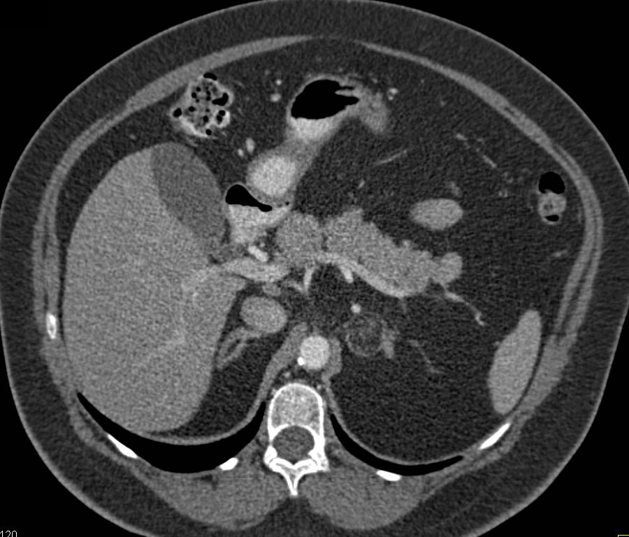 Adrenal Myelolipoma in Patient with Crohn's Colitis - CTisus CT Scan