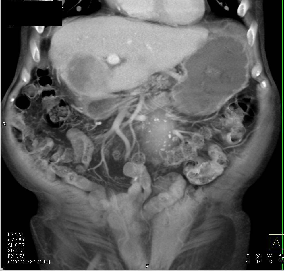 Hepatocellular Carcinoma (Hepatoma) with Right Adrenal Metastases - CTisus CT Scan