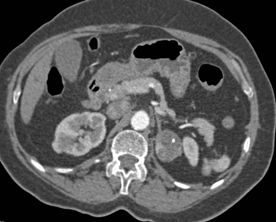 Myelolipoma of the Left Adrenal Gland - CTisus CT Scan