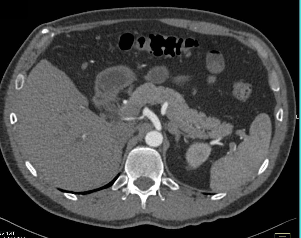 Left Adrenal Adenoma - CTisus CT Scan