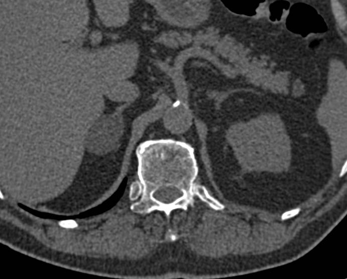 Classic Adrenal Adenoma with Attenuation Value of 0HU - CTisus CT Scan