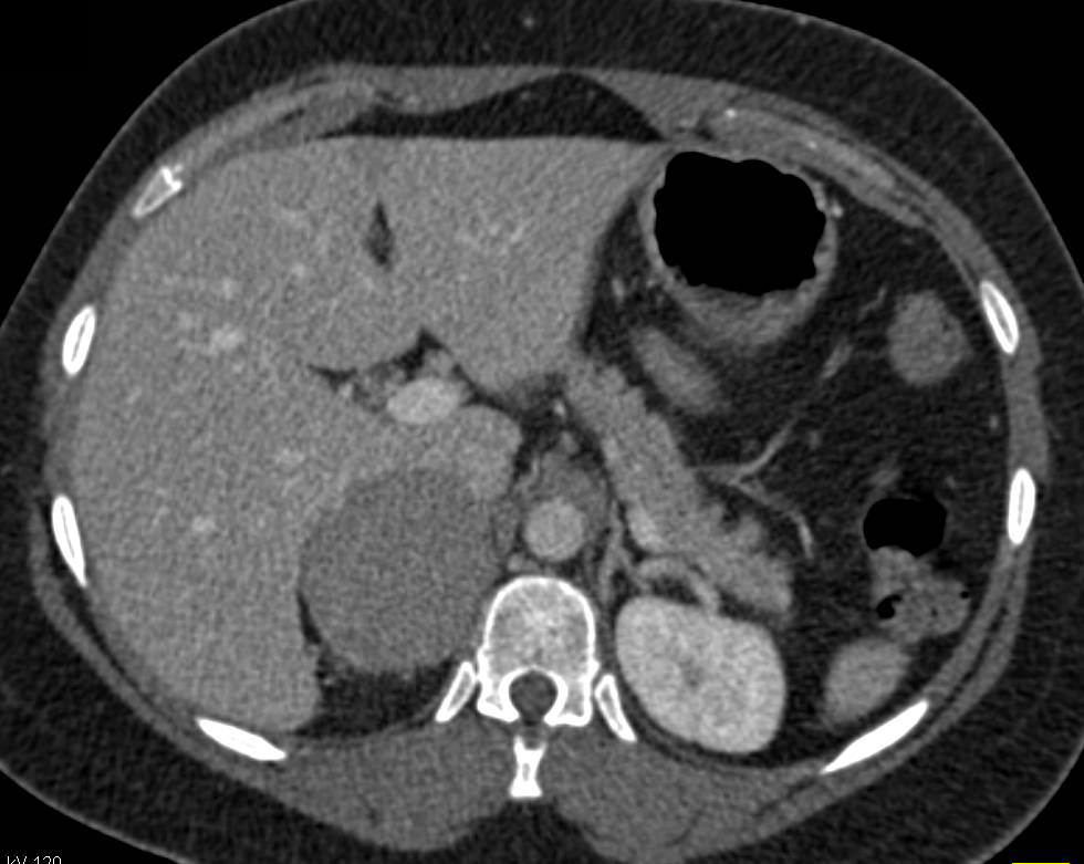 Primary Adrenal Carcinoma - CTisus CT Scan