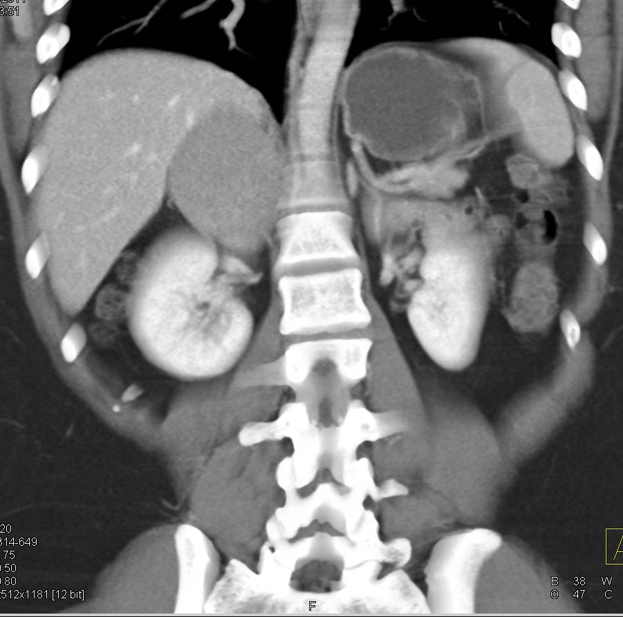 Primary Adrenal Carcinoma - CTisus CT Scan