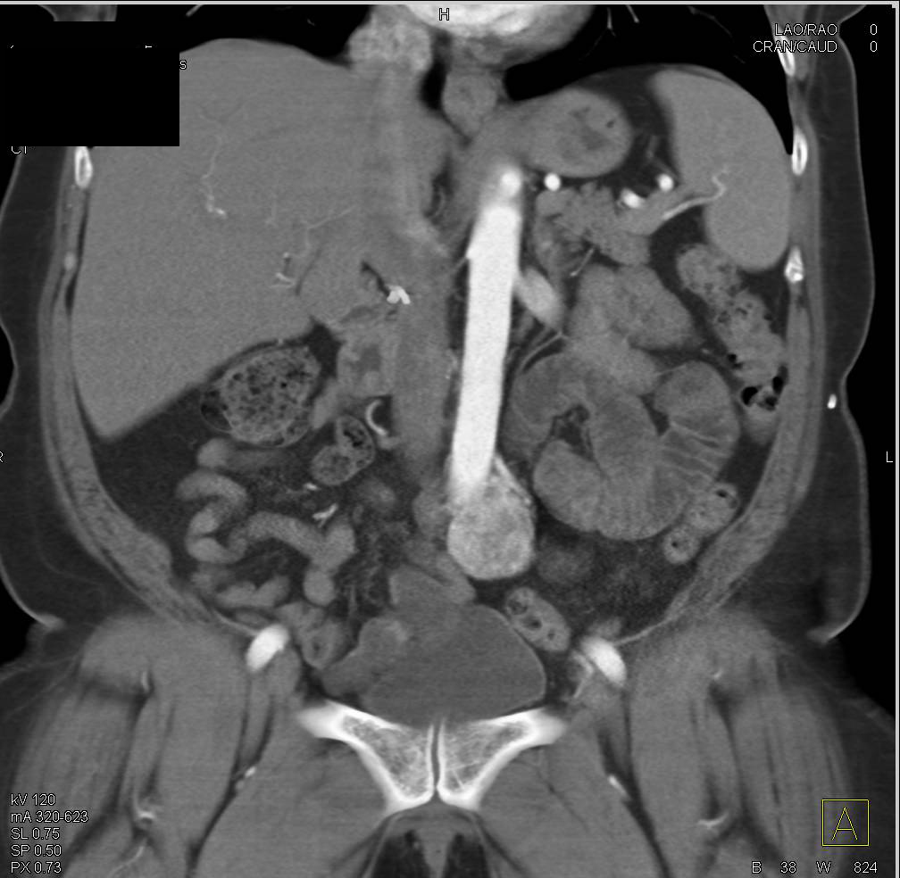 Extra-Adrenal Pheochromocytoma at Organ of Zuckerkandl - CTisus CT Scan
