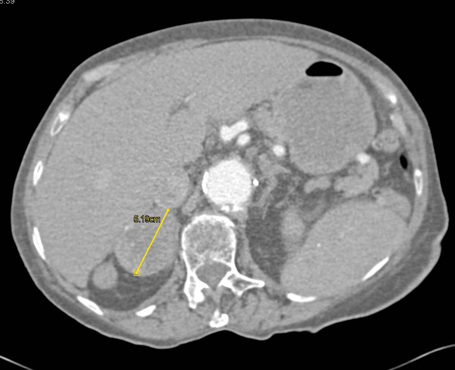 Old Adrenal Hematoma on the Right Adrenal - CTisus CT Scan