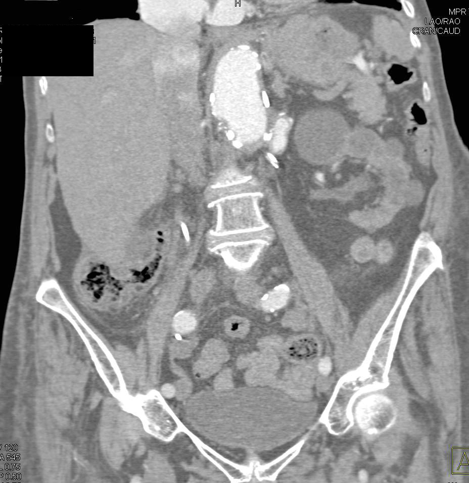 Old Adrenal Hematoma on the Right Adrenal - CTisus CT Scan