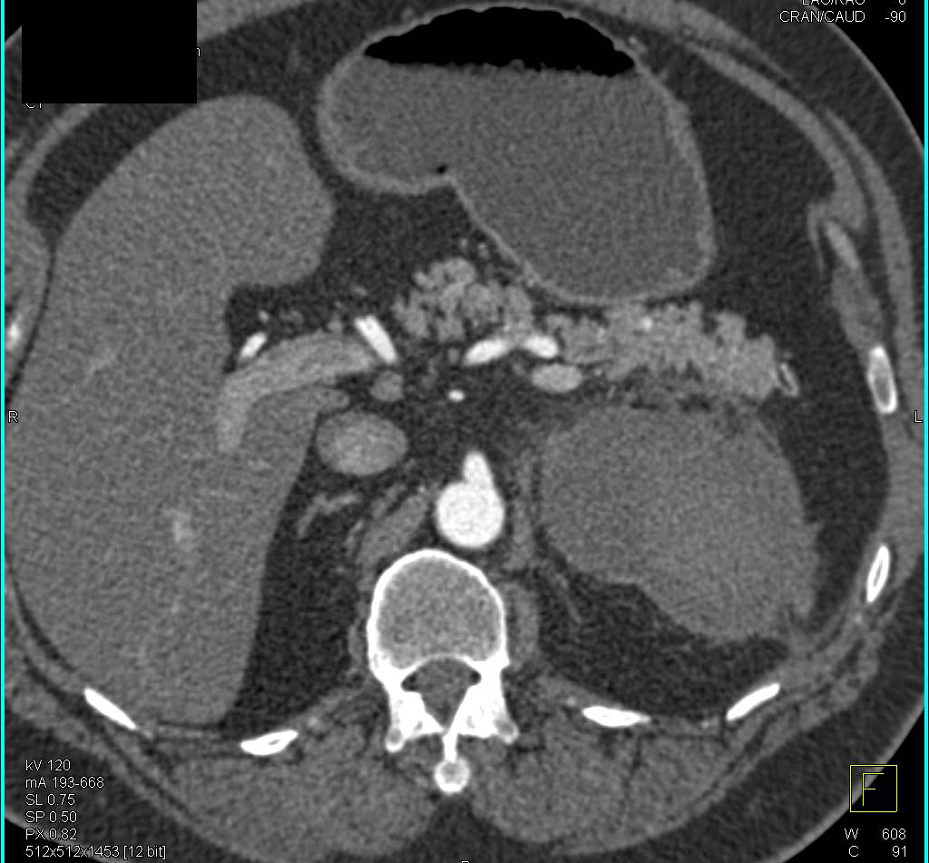 Hematoma in the Left Adrenal Bed - CTisus CT Scan