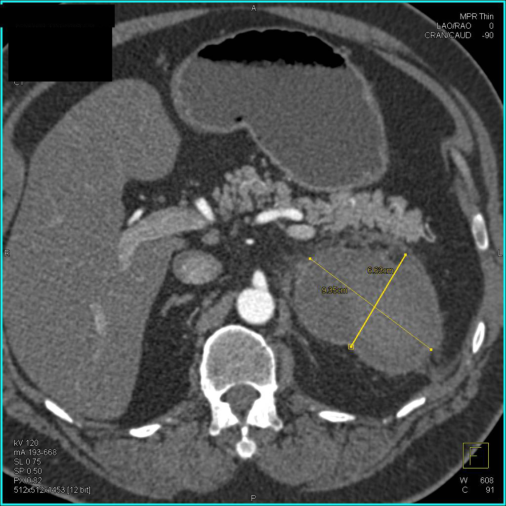 Left  Adrenal Hematoma - CTisus CT Scan