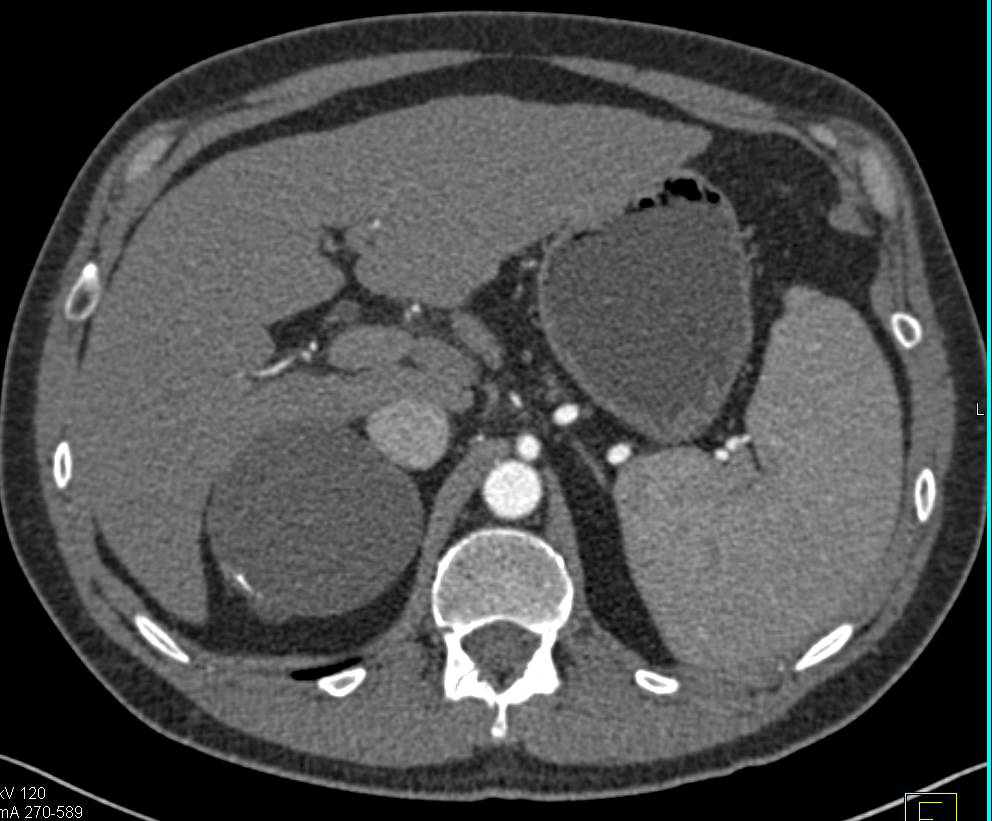 Right Adrenal Cyst with Faint Calcification in the Cyst Wall - CTisus CT Scan