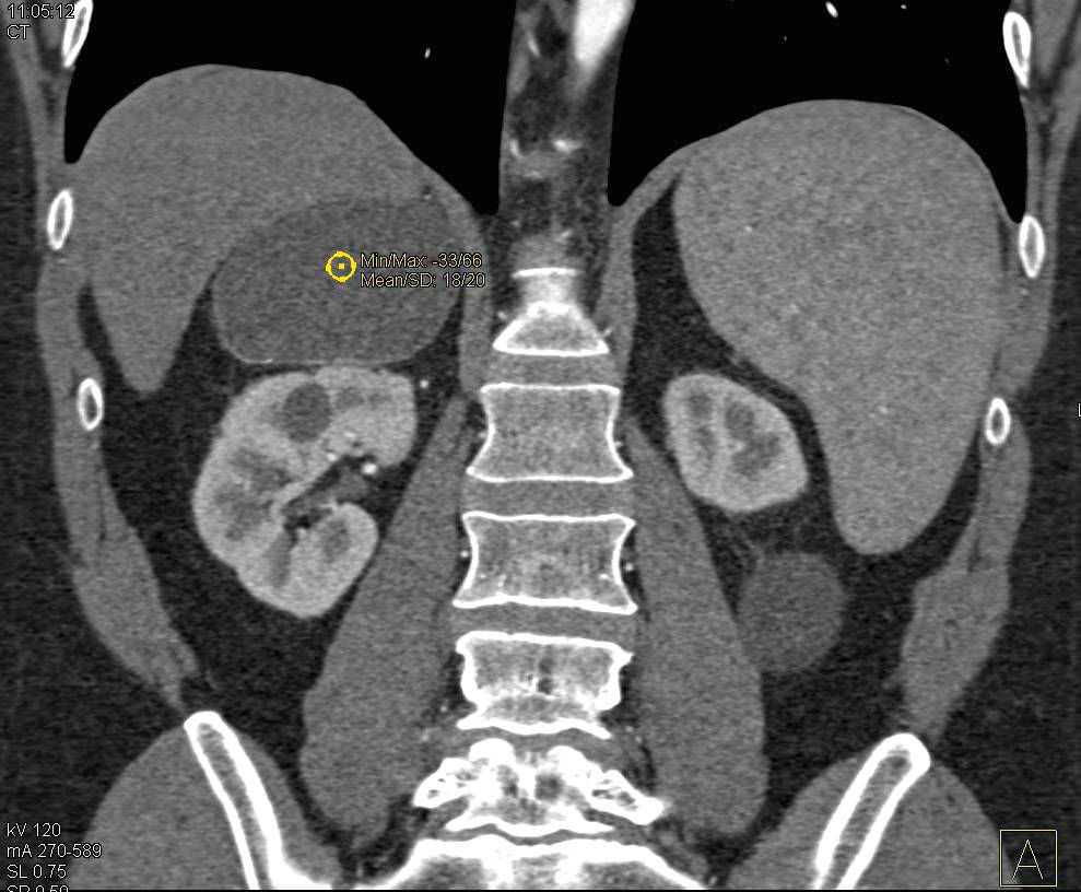 Right Adrenal Cyst with Faint Calcification in the Cyst Wall - CTisus CT Scan