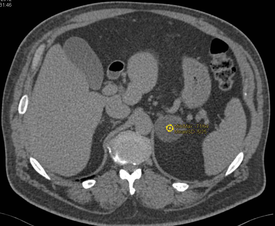 Left Adrenal Adenoma - CTisus CT Scan