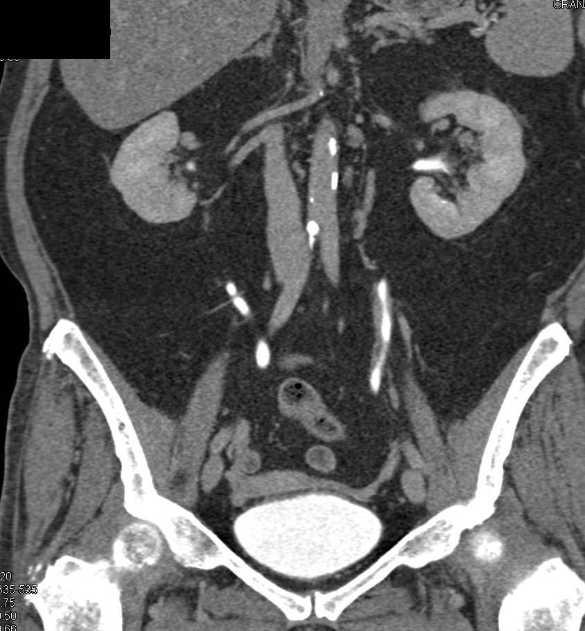 Transitional Cell Carcinoma of the Left Ureter - CTisus CT Scan