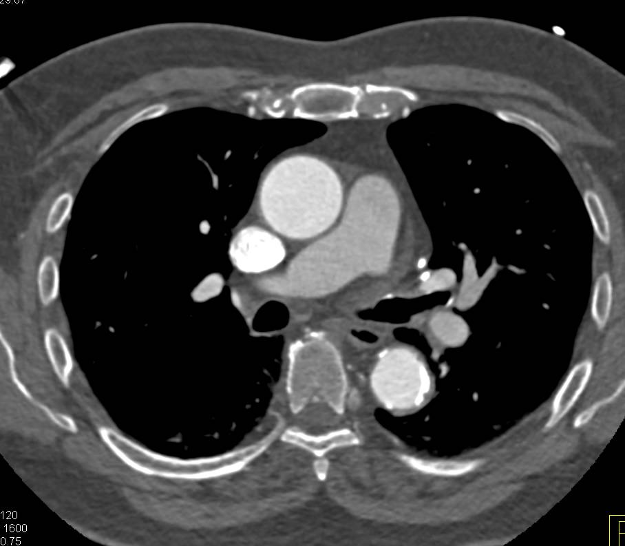 Triple Rule Out with Good Opacification of Arteries and Veins - CTisus CT Scan