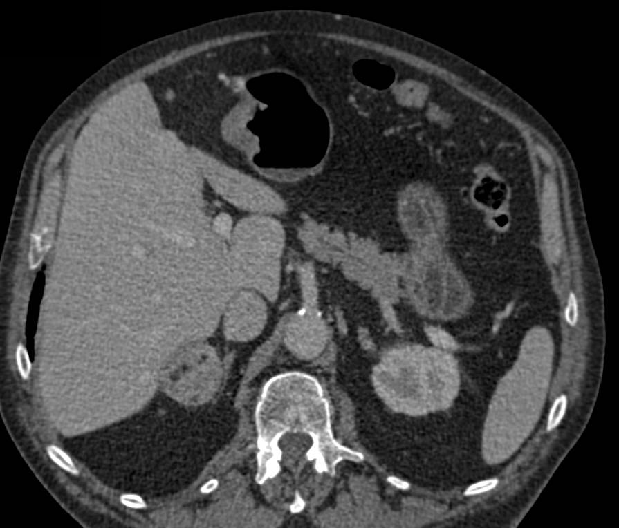 Incidental 1 cm Right Renal Carcinoma - CTisus CT Scan