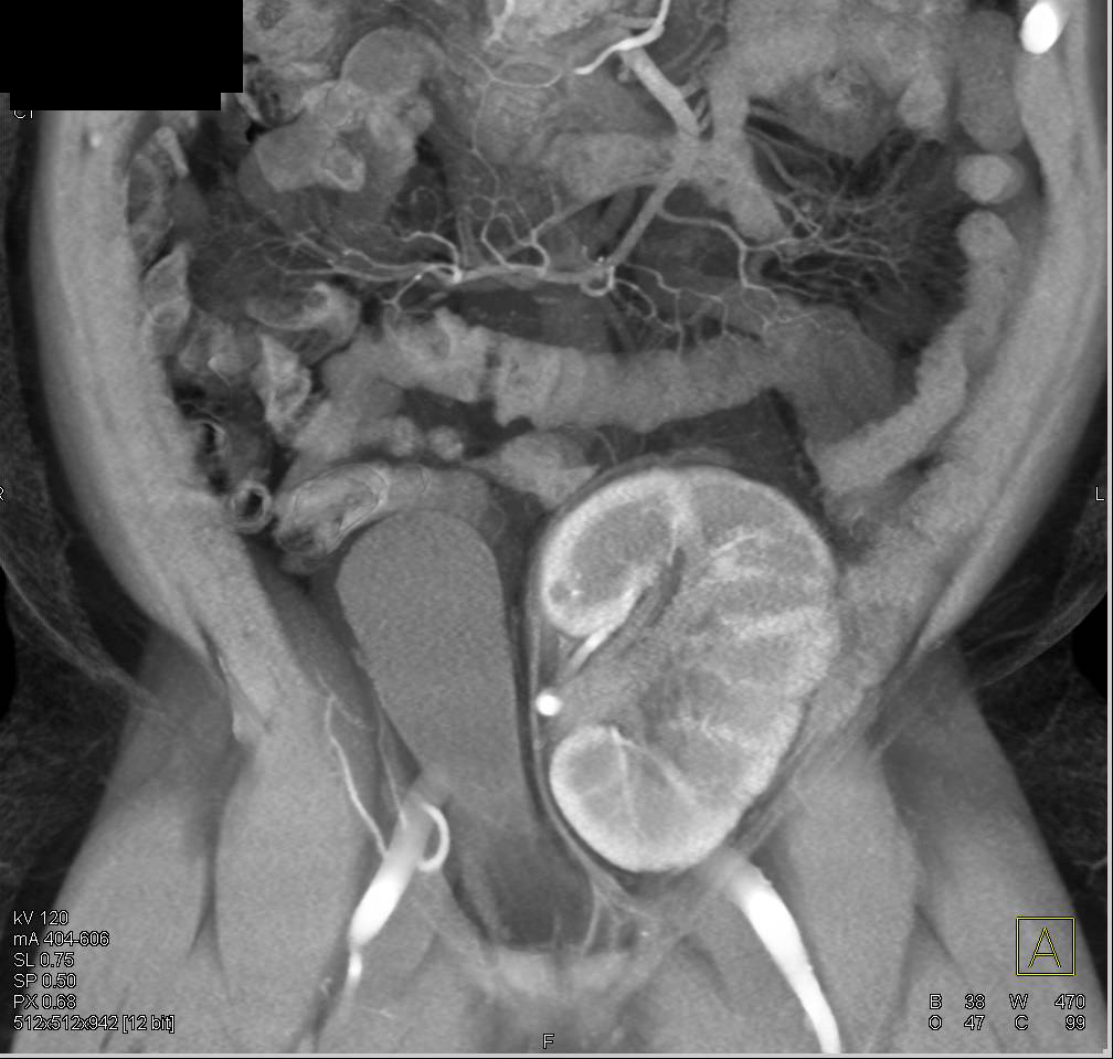 Vascular Mapping of a Renal Transplant - CTisus CT Scan