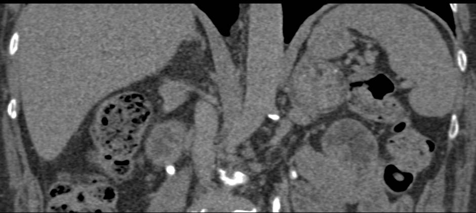 Left Adrenal Myelolipoma - CTisus CT Scan