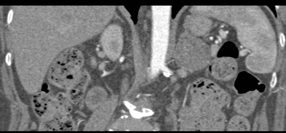 Adrenal Myelolipoma - CTisus CT Scan