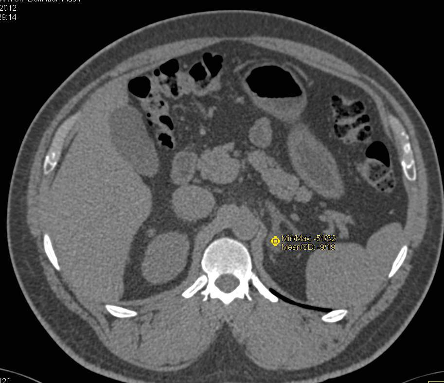 Left Adrenal Adenoma - CTisus CT Scan