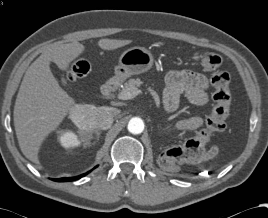 Left Nephrectomy for Renal Cell Carcinoma with Right Adrenal Metastases - CTisus CT Scan