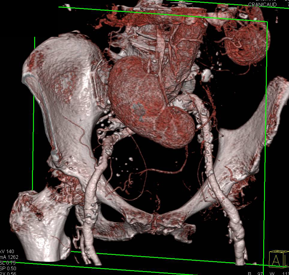 Pelvic Transplant Kidney and Aortic Aneurysm - CTisus CT Scan