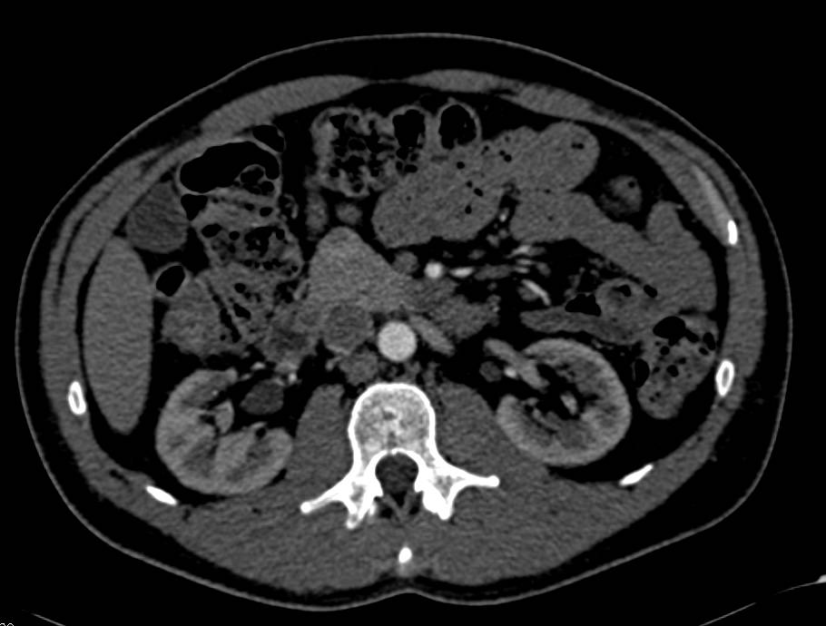 Left Adrenal Adenoma - CTisus CT Scan