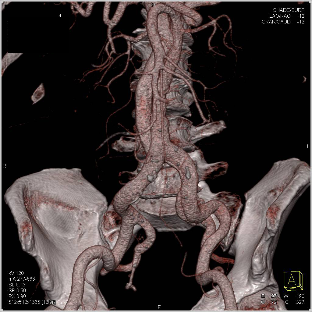 Aortic Dissection - CTisus CT Scan