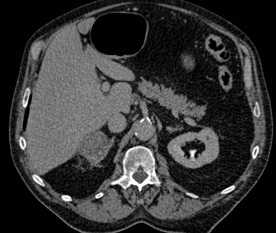 Myelolipoma of the Right Adrenal Gland - CTisus CT Scan