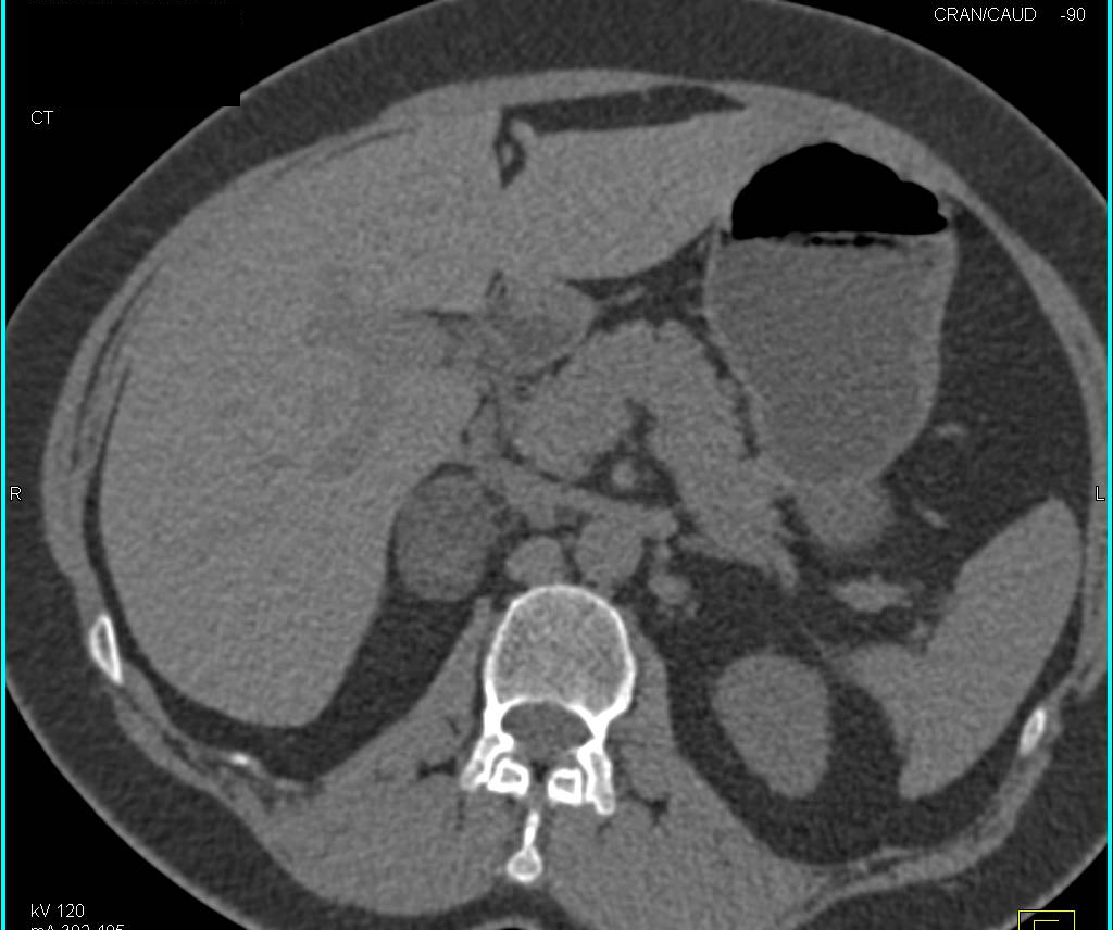 Right Adrenal Adenoma with Washout - CTisus CT Scan