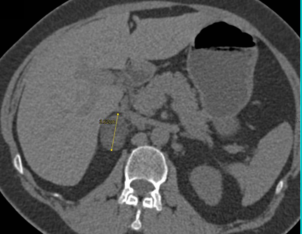 Right Adrenal Adenoma - Adrenal Case Studies - CTisus CT Scanning