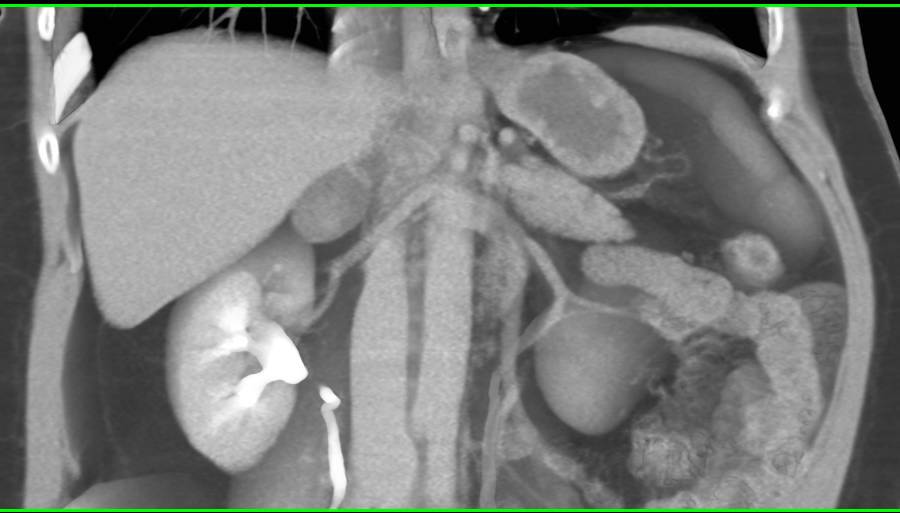 Right Adrenal Adenoma - CTisus CT Scan